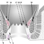 геморроидальные узлы