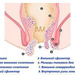 Hemorrhoids