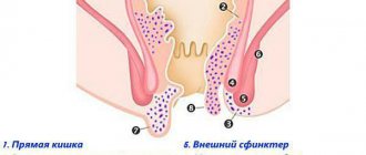 Геморроидальные узлы