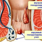 Геморроидальные узлы