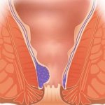 Геморрой – это заболевание аноректальной зоны, при котором происходит варикозное изменение геморроидальных вен дистального отдела прямой кишки