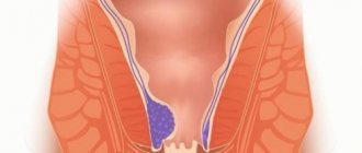 Геморрой – это заболевание аноректальной зоны, при котором происходит варикозное изменение геморроидальных вен дистального отдела прямой кишки