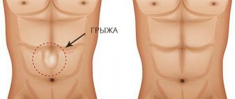 hernia of the white line of the abdomen.jpg