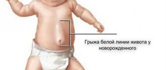 Hernia of the white line of the abdomen in a child