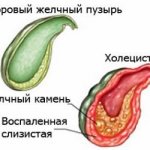 Cholecystitis is an inflammatory disease of the gallbladder