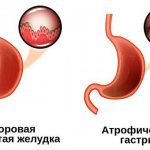 chronic focal atrophic gastritis symptoms