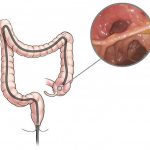 Ileocolonoscopy