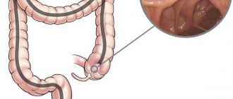 Ileocolonoscopy