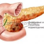 Изменение структуры поджелудочной железы