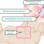 Как лечить пупочную грыжу новорожденного пластырем