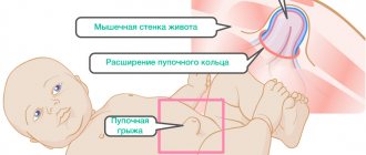 Как лечить пупочную грыжу новорожденного пластырем