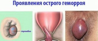 What does acute hemorrhoids look like?