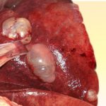 Cysts in the liver