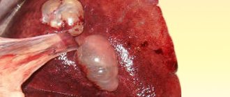 Cysts in the liver