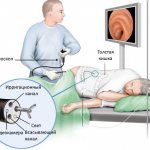 колоноскопия