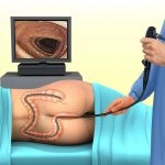 colonoscopy under anesthesia