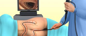 colonoscopy under anesthesia