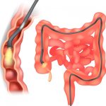 Colonoscopy, diagram