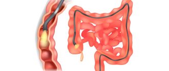 Colonoscopy, diagram