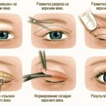 xanthoma: causes of appearance