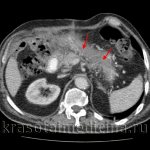 CT OBP. Pancreatic necrosis. Diffuse edema and disruption of the structure of the pancreas, lack of accumulation of contrast in its parenchyma. 