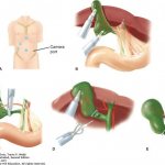 Laparoscopic cholecystectomy