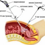 Laparoscopy