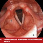 Treatment of patients with dysphonia in gastroesophageal reflux disease