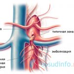 Mesenteric thrombosis