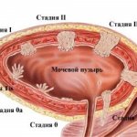 Множественные полипы способствуют перерождению клеток в злокачественные, тогда образуется рак желчного пузыря