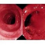 In the photo you can see different pictures of damage to the colon, associated with the scale of the inflammatory process and its localization.