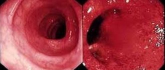 In the photo you can see different pictures of damage to the colon, associated with the scale of the inflammatory process and its localization.