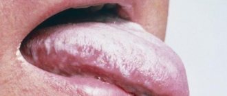 Налет на языке может говорить о массе различных заболеваний