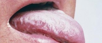 Plaque on the tongue can indicate a lot of different diseases.