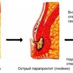 formation of a fistula with paraproctitis