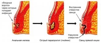 formation of a fistula with paraproctitis