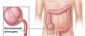 Danger of inflammation of appendicitis