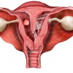 Main types of pathology of the uterine cavity