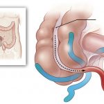 Deviation of the appendix body