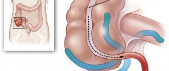 Deviation of the appendix body