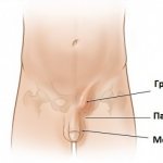 inguinal hernia