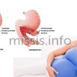 Pancreatitis during pregnancy