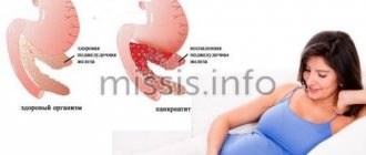 Pancreatitis during pregnancy