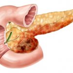 Pancreatitis