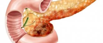 Pancreatitis