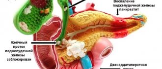 Pancreatitis