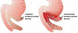 Pancreatitis