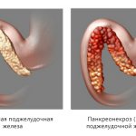 Pancreatic necrosis of the pancreas