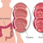 According to statistics, when visiting a gastroenterologist, 40% of patients are diagnosed with a chronic form of the disease.