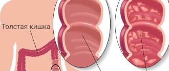 According to statistics, when visiting a gastroenterologist, 40% of patients are diagnosed with a chronic form of the disease.